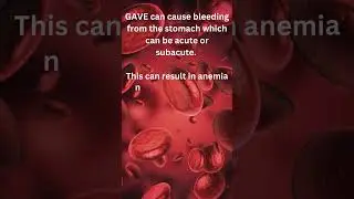 Med Minute -What is Watermelon Stomach