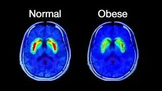 The Brain's Impact On Obesity And How Trubrain Can Help.