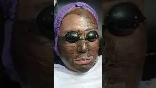 FROM DASMARI&Ntilde;AS CAVITE! BLACK CARBON LASER WITH GLYCOLIC ACID PEELING!!!