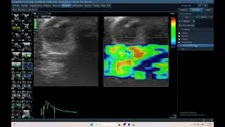 IQ 720 HYPERPLASIA MENINGIA ELASTOGRAPHY SR2 ULTRASOUND