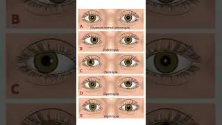 Tipos de estrabismo