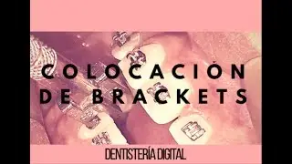 BRACKETS- Cómo se ponen los brackets? Sin dolor