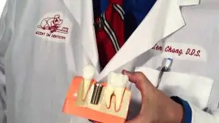 Dental Implants Anchorage Replace Missing Teeth at Accent on Dentistry