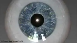 KAMRA Inlay at Maloney Vision Institute - Reading Vision Correction