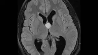 Colloid Cyst
