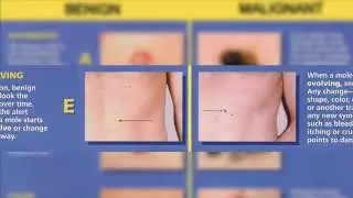 Melanoma Treatment with Dr. Shauna Diggs