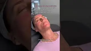Microneedling for mature skin ✨