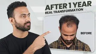 Hair Transplant in Raipur (HX-IUYW) | Best Results & Cost of Hair Transplant in Raipur