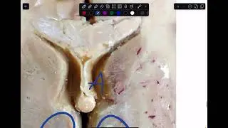 Basal nuclei, internal capsule and diencephalon practical