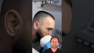 CO2 Laser Self Treatment- Surgeon Reacts