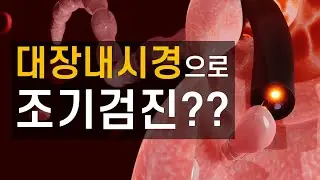 대장내시경을 통한 대장암 조기검진의 가치는 얼마나 될까?