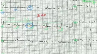 ECG de A à Z : exercice 3 + correction