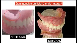 Prótese com gengiva artificial e a natural
