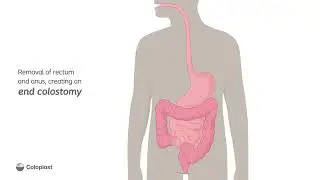 Creation of end colostomy by removing rectum and anus | Ostomy surgery | Coloplast India