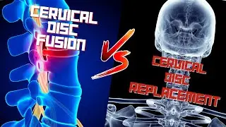 Which Surgery Should YOU Get for Neck Pain: Cervical Fusion or Cervical Disc Replacement?