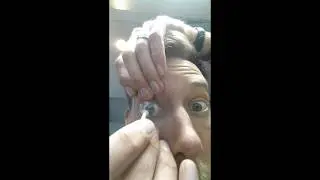Scleral lens removal technique close-up variation from Mr Alex Petty, Bay Eye Care NZ