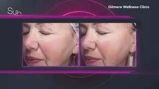Candela Sublative RF in Vancouver Matrix Mechanism