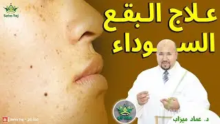 وصفات طبيعية للتخلص من النقط السوداء في بشرة الوجه / وصفات الدكتور عماد ميزاب wasafat imad mizab