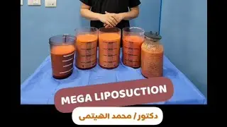 تقنية ميجا ليبوسكشن mega liposuction د محمد الهيتمى
