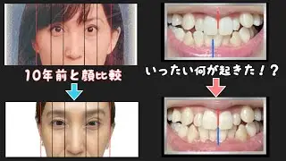 【歯列矯正8ヶ月】正中線が急に合った！左右差ひとつ解消♪顔の変化の意外な原因は〇〇だった！