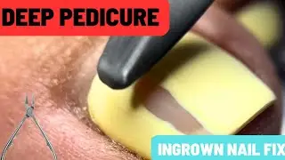 Extreme Deep Cuticle Cleaning | Russian Pedicure Transformation