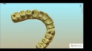 Ibar Bionic Abutment