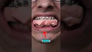 Никогда не жуйте жвачку, нося брекеты! Вот почему❗ #шорты