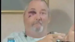 Man shot in face speaks out
