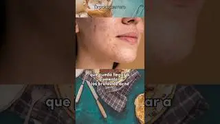 Alimentos que empeoran el acn&eacute;, episodio completo en mi perfil #sabiasque #medicina