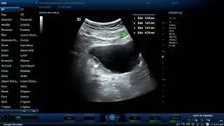 33mm staghorn renal PCS calculus and 14mm stone impacted in the Rt. ureterovesical junction