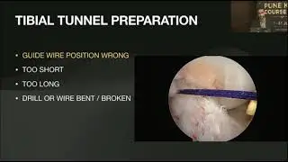 Common Complications and Bailout - Primary ACL Construction - Dr Billy Paul Wilson 2