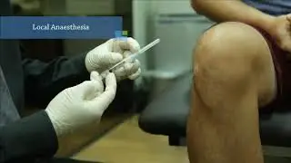 Injecting Orthovisc using the lateral approach (sitting up)