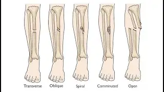 Forearm fractures, Femur or tibia fractures, Clavicle fractures