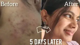 Skin Barrier Repair: How to Fix Damaged Skin Barrier Fast | Best Skincare Products & Tips