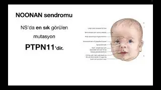 Noonan sendromu, bir solukta...