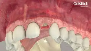 Geistlich BioOss + Geistlich BioGide Preservacion tridimensional de la cresta