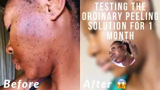 Обзор обычного пилинга за 4 недели (до и после) с Tik Tok заставил меня это сделать