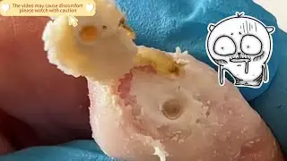 Pimple Popping Ep.29 &ndash; Giant Foot Wart Removed with Root!