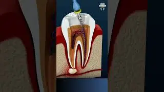 Tooth Infection & Its Treatment | Root Canal Treatment (RCT) | 3D Animation | #rootcanaltreatment