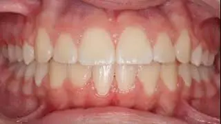 Gessel Orthodontics - Smile Transformation with Braces or Invisalign - Tacoma, WA Orthodontist