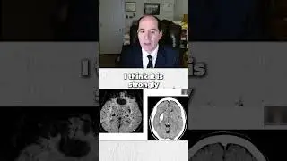 What is amyloid angiopathy of the brain?