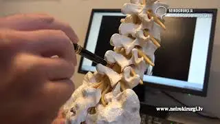 Kā rodas mugurkaula stenoze, jeb mugurkaula kanāla sašaurinājums?