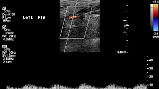 Tardus-Parvus Doppler Waveform in severe Multilevel or Diffuse Arterial Disease | Doppler Ultrasound