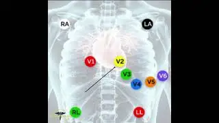 ECG PLACEMENT - 12 LEAD ECG