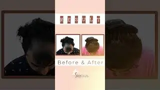 ✨ Before ➝ After | Hair Transplant Transformation ✨