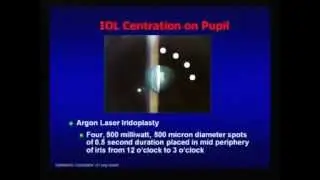 Excimer Laser Photoablation Following Refractive IOL Surgery