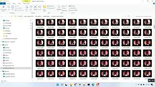 Esophageal Fusion Image Classification CNN Flask App in Python Projects