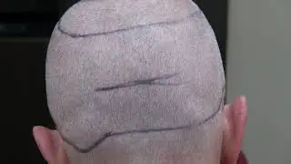 Minimal FUE Donor Scar Demonstration by Dr. Diep