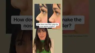 How does nose filler make the nose appear smaller?👃🏽 #nonsurgicalrhinoplasty #nosejob #fillers