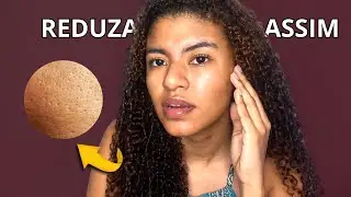 Poros dilatados: D&aacute; para fechar poros? Saiba as causas e tratamento para poros dilatados